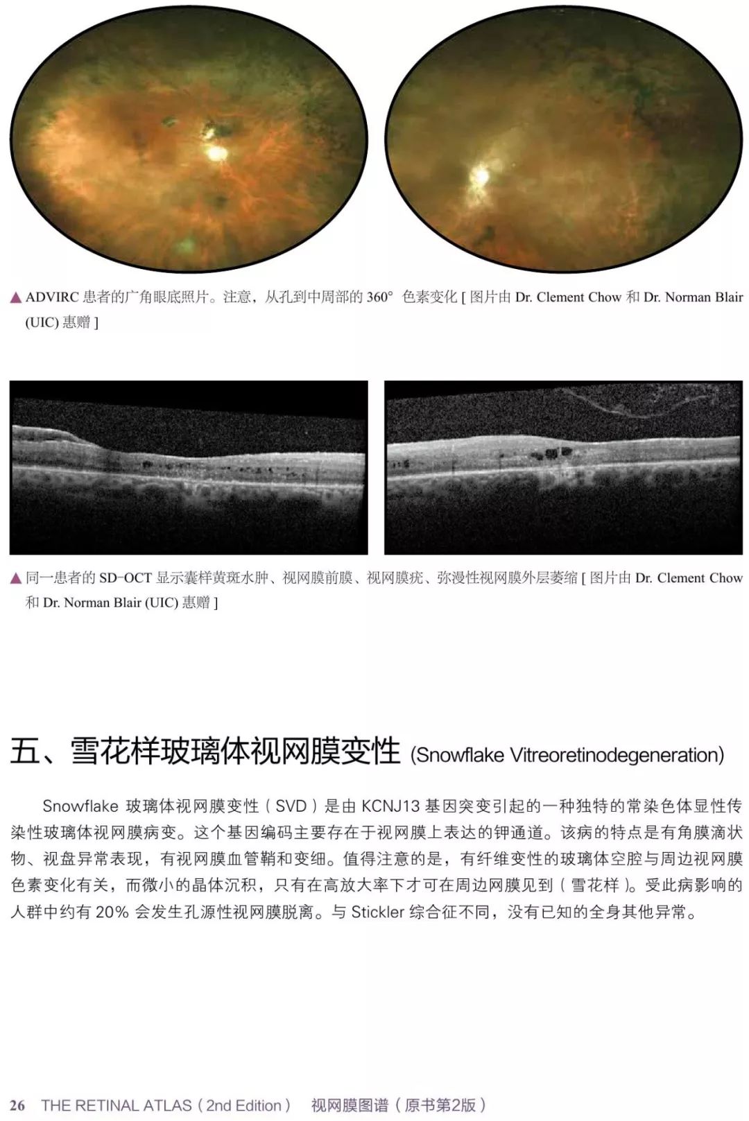 眼底病变眼睛图片,眼底病变的高清挂图