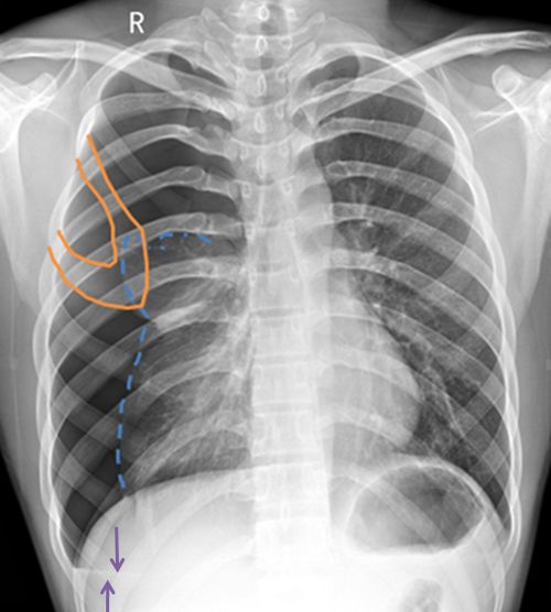 气胸的x线表现胸膜炎,胸外科气胸病人病例