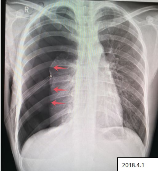 气胸的x线表现胸膜炎,胸外科气胸病人病例