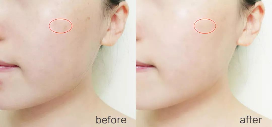 美白针可以10天打一次吗,可以美白的针