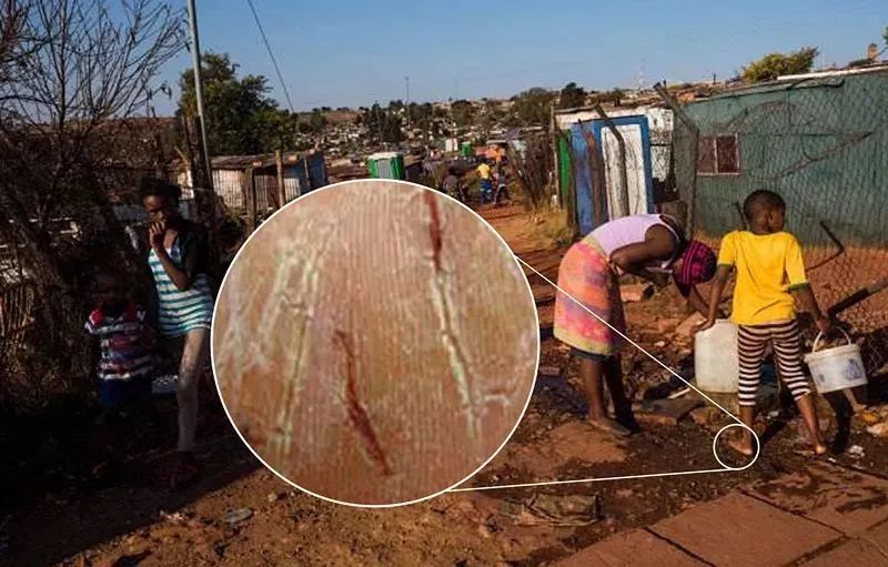 湿疹晒伤后抹什么药膏,日晒皮炎湿疹用什么止痒