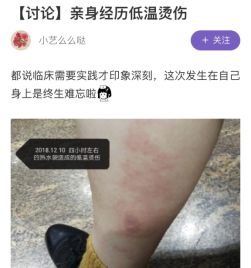 热水袋烧伤,热水袋烧伤起泡怎么处理