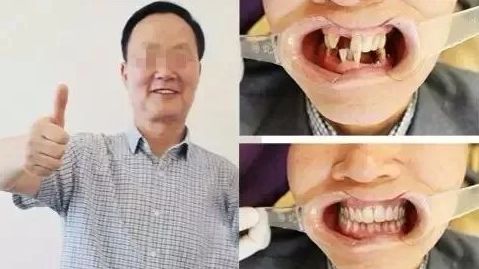 急急急！全城寻找缺牙、难看牙市民，每人最高获助20000元！