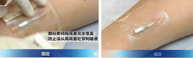 扎留置针有回血送针失败,留置针回血穿刺失败