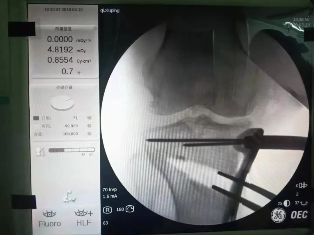 胫骨高位截骨术的适应症,胫骨截骨术hto是微创吗