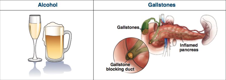 急性胰腺炎精华总结，值得一看！