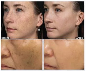 严重痘印晒斑,5个祛斑小妙招淡化晒斑雀斑痘印