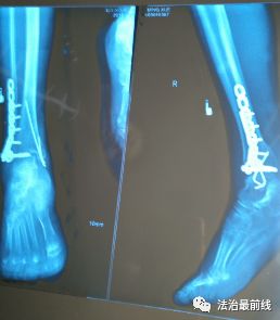 骨折手术后两个月去取钢钉,女子骨折2个月