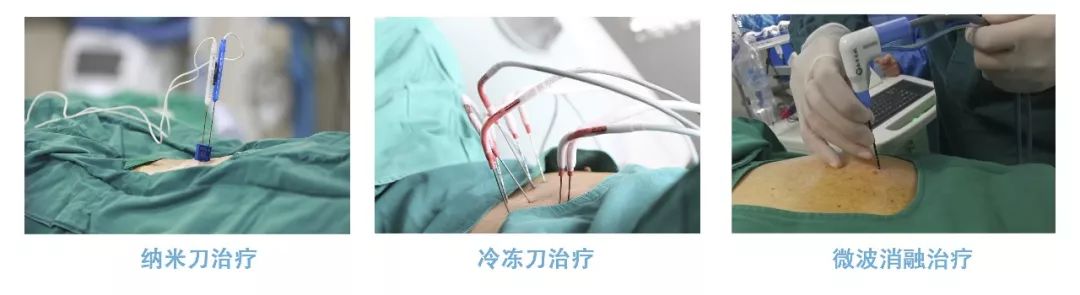 冷冻治疗的恢复需要多久,冷冻治疗恢复过程图片