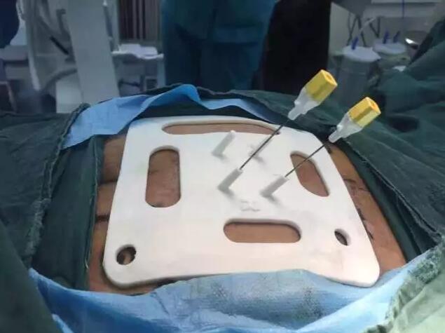 3D打印助力骶神经调节手术西安市红会医院创西北第一例