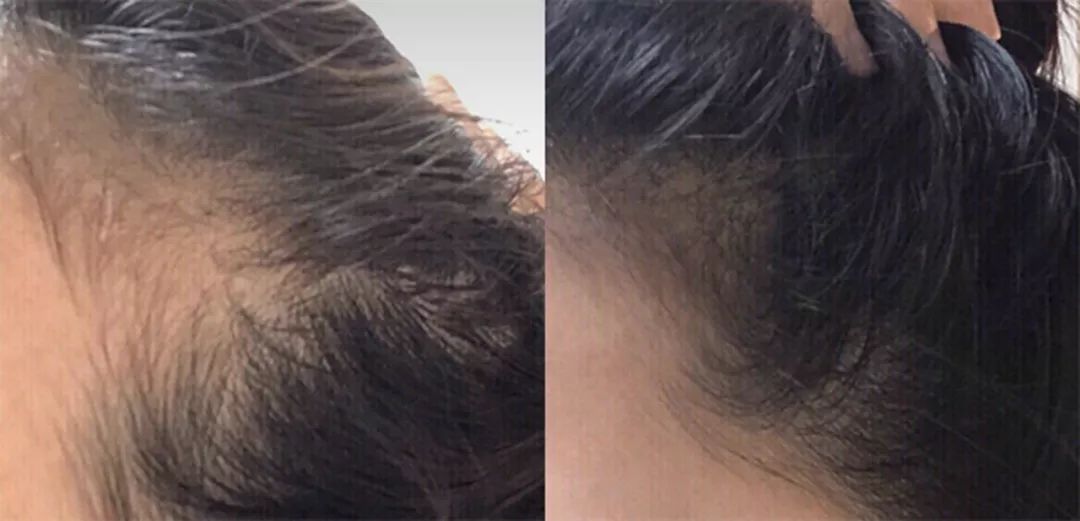 发际线防脱发神器,增发神器发际线