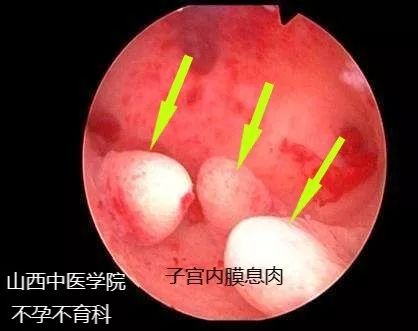 不孕症宫腔镜,不孕症的微创手术