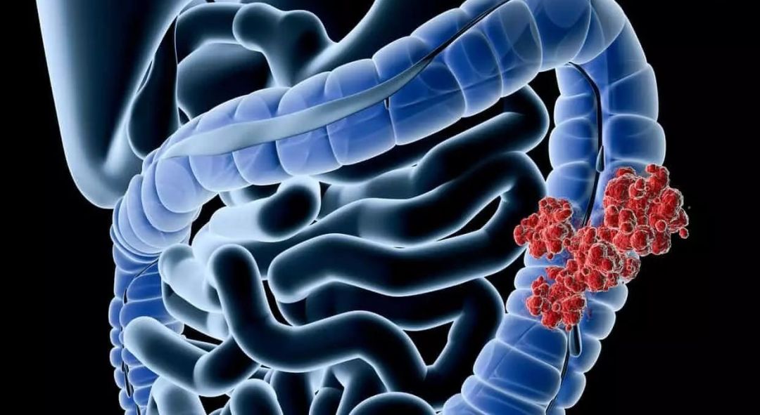 容易癌变的息肉有哪些,什么样子的息肉容易癌变