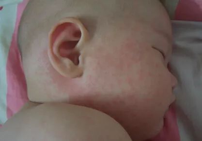 儿童常见皮疹及处理方法,儿童春季高发皮肤病