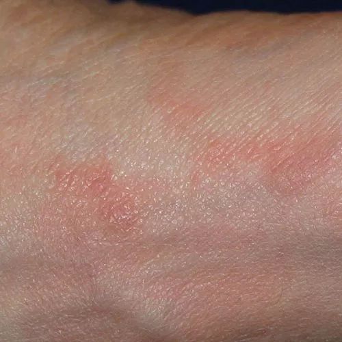 痒痒痒！疥螨会在皮肤内挖掘隧道