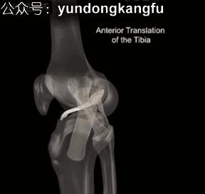 膝腓侧副韧带损伤怎么恢复,膝内侧副韧带损伤修复视频