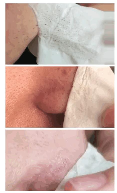 又爽又恶心的去黑头方法来了！5分钟将你10年的黑头白头连根拔起！