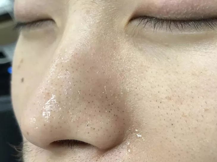 清洁毛孔|又爽又恶心的去黑头方法来了！5分钟将你10年的黑头白头连根拔起