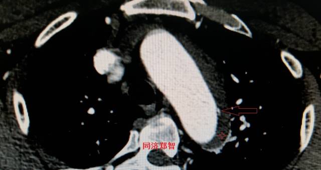 没有cta这三招也能识别主动脉夹层,磁共振可以替代cta检查主动脉夹层