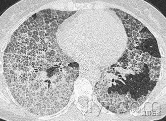胸部解剖及常见疾病影像表现,胸部影像学基础知识