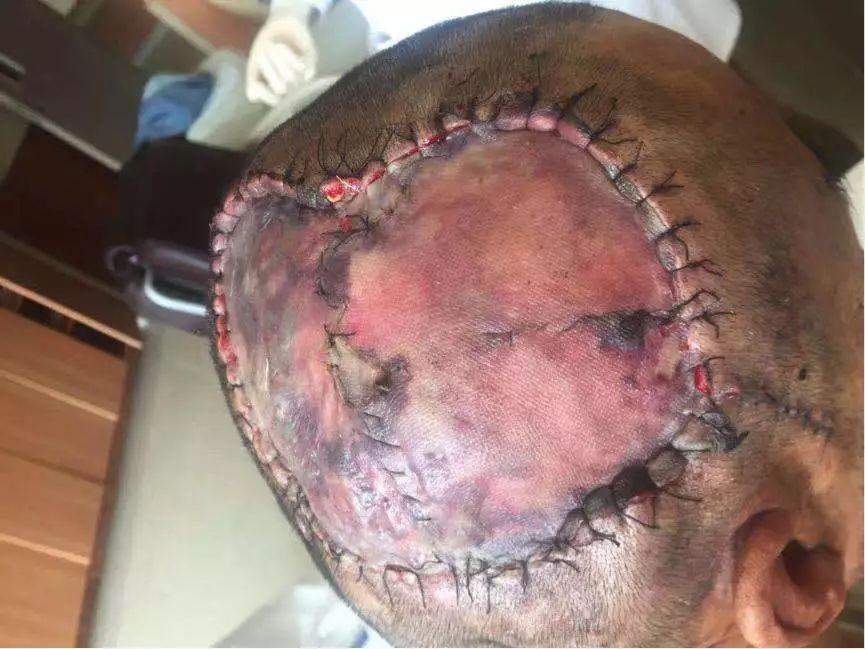 清华长庚医院混合瘤,清华长庚血管外科