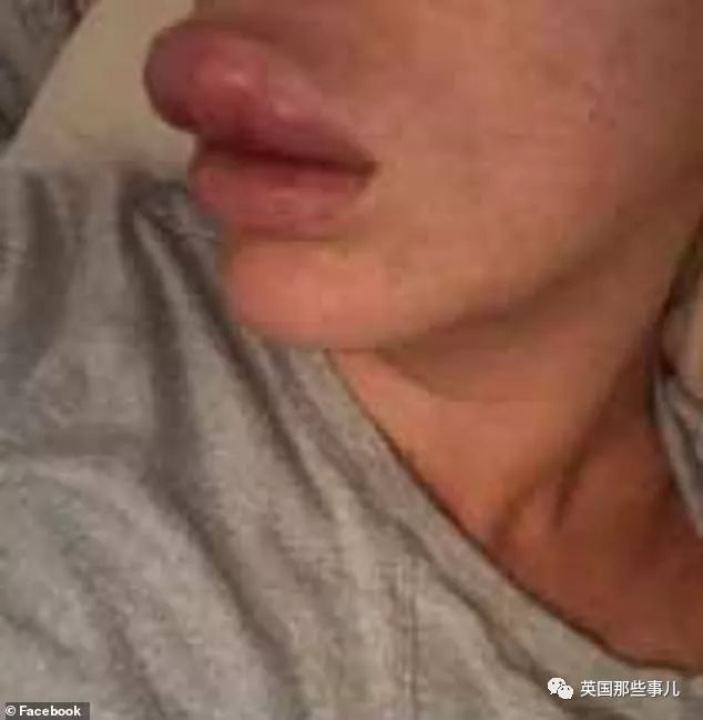 丰唇后肿成香肠嘴过几天会消失吗,在朋友家里玩香肠派对