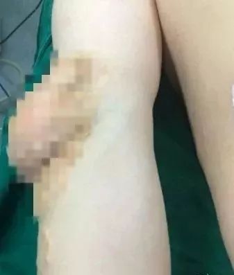 30岁小伙长了奇怪肿瘤,26岁小伙得罕见怪病