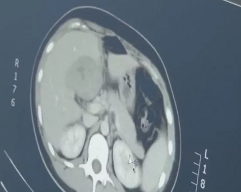 女子怀孕三个月肚子却很大,女子怀孕3个月发现肚里没胎儿