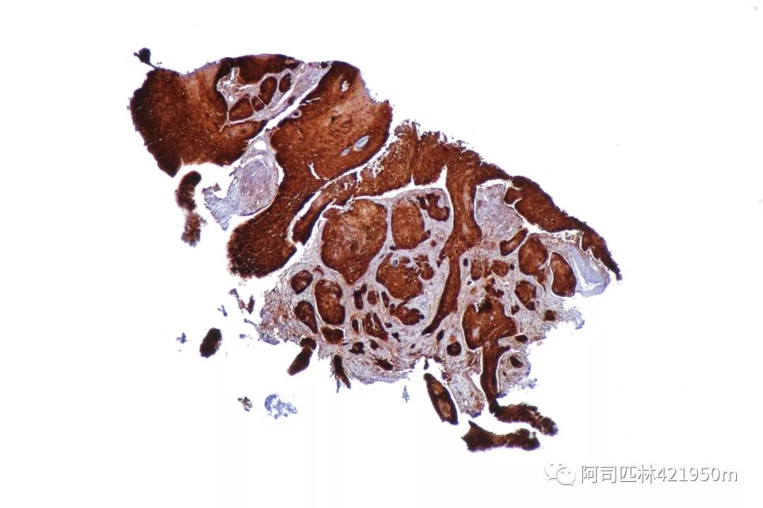 大便拉血怎么区分是痔疮还是癌症,到底是便秘还是痔疮