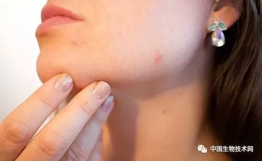 湿疹诱因：或是皮肤微生物组生态失调