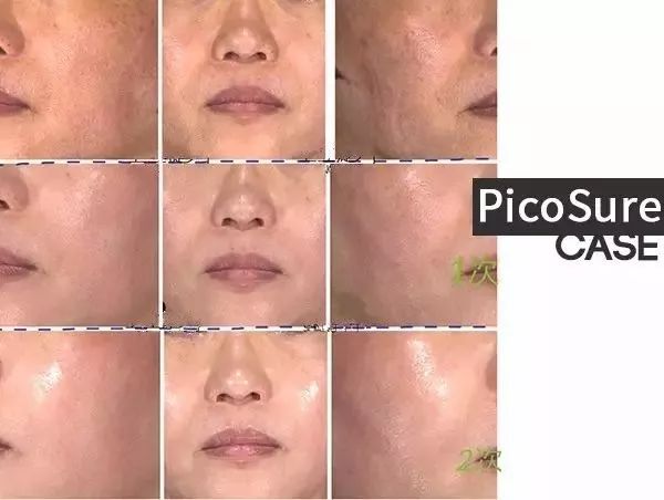 皮秒激光和调q激光哪个先进,皮秒激光消除色素沉着有效吗