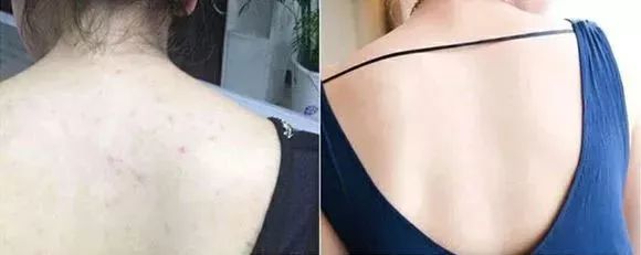 不用洗床单晒被子怎么除螨虫,螨虫去除妙招不用花露水