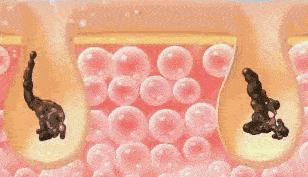 鼻尖挤出白色的是什么,鼻子上挤出的白丝怎么解决