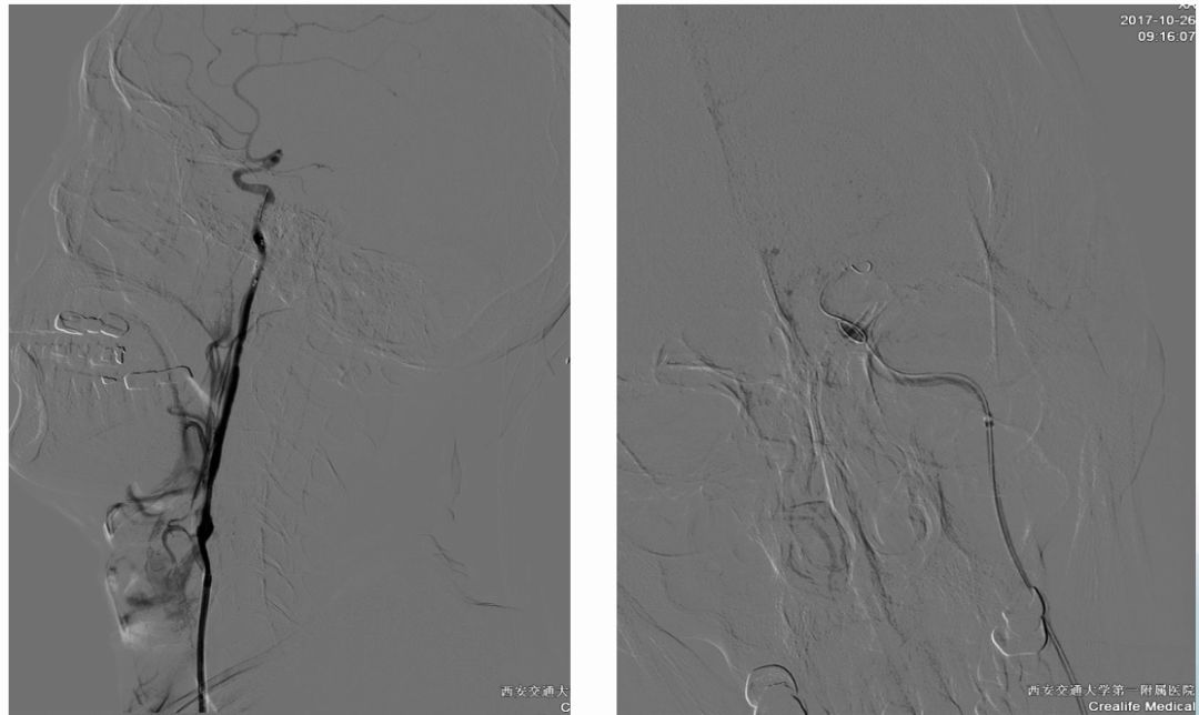 径技·例量|25期：再灌注出血—防不胜防