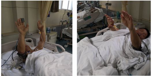 径技·例量|25期：再灌注出血—防不胜防