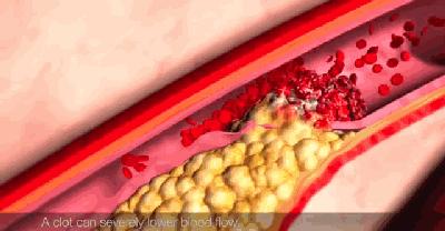 血脂高降脂最快的方法,教你降脂4大手段