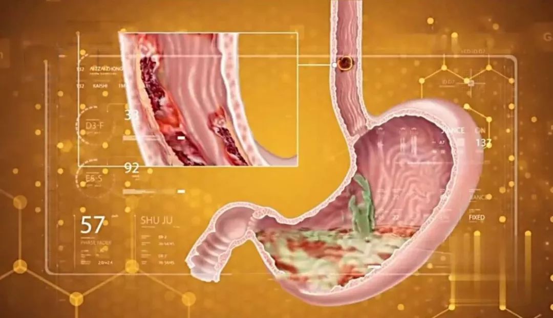 细菌病毒感染导致癌症,20多种癌症