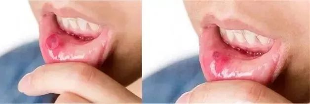 去除黄牙牙垢的牙膏,去口臭黄牙牙垢的牙膏