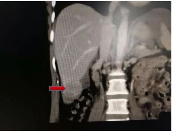 妈妈突然肚子疼浑身无力冒冷汗,妈妈突然肚子疼孩子照顾