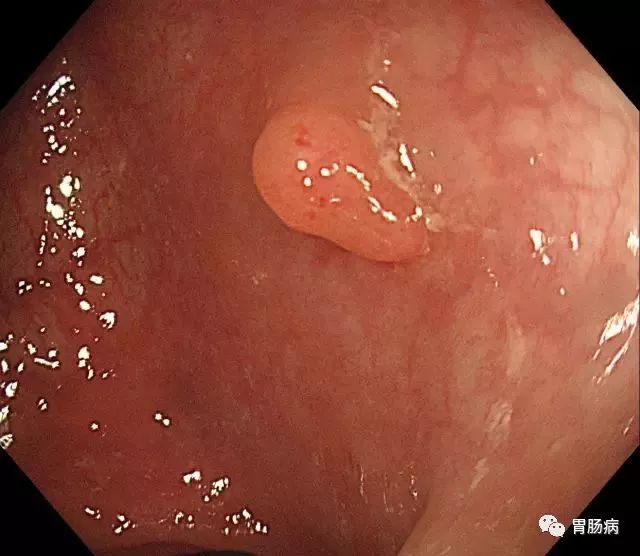 结肠息肉切除术术前准备,结肠镜下息肉冷切除术