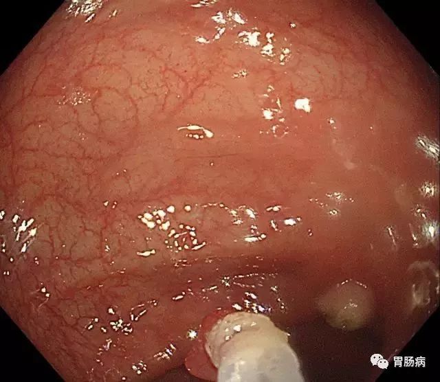 结肠息肉切除术术前准备,结肠镜下息肉冷切除术