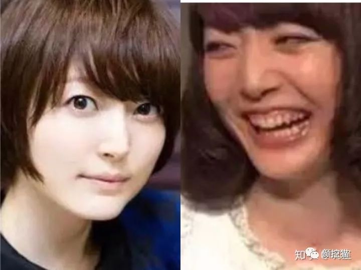 一笑露牙花子能矫正么,一笑就露出牙花怎么办