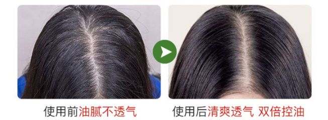 头皮除螨虫神器哪种好用,除头螨头屑小窍门