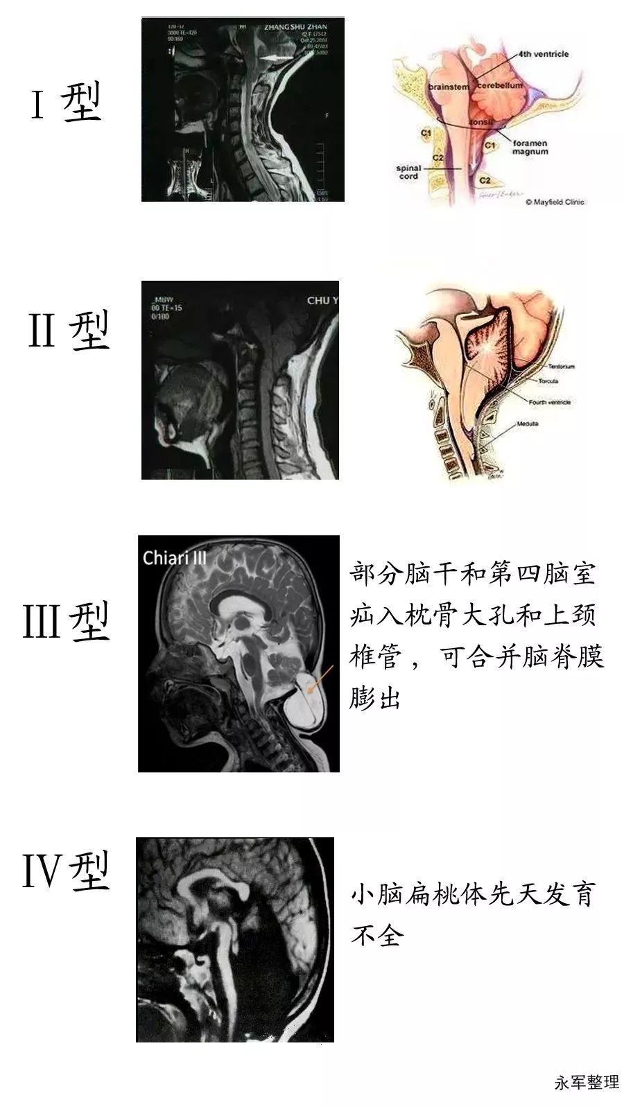 Chiari畸形1型伴脊髓空洞症能自愈吗？