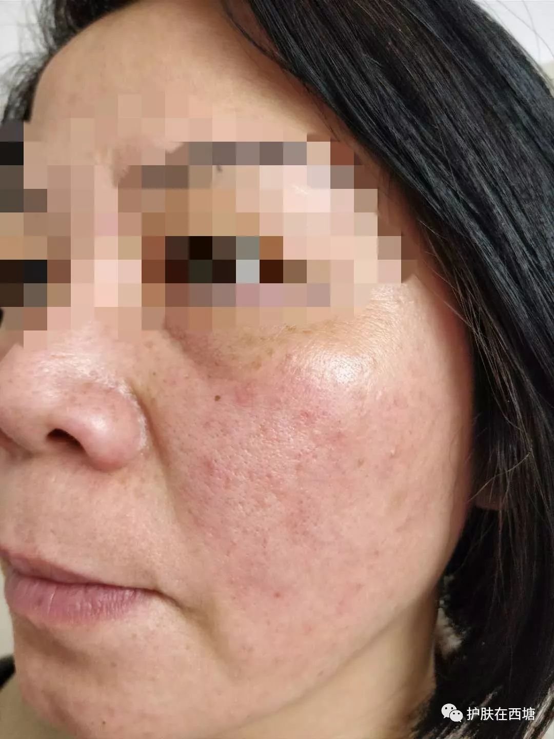 面部敏感性皮炎科普知识,激素依赖性皮炎是什么皮肤病