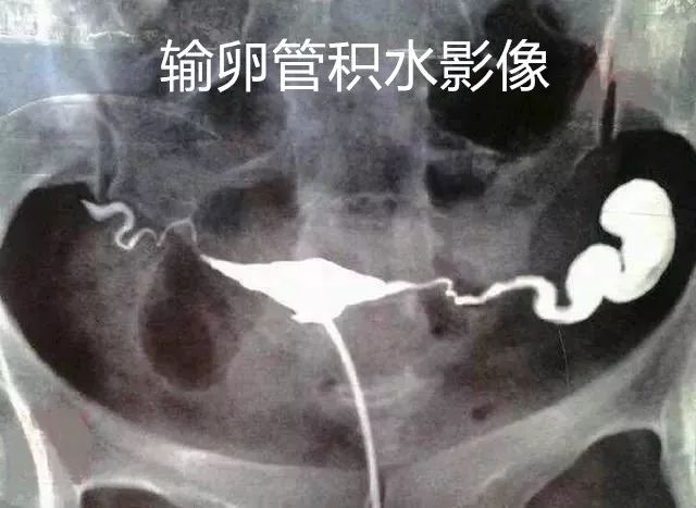 治不孕不育案例,专治不孕不育输卵管疏通祖传秘方