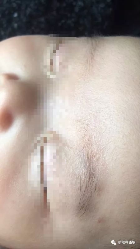 头皮脂溢性皮炎怎么彻底根除,毛囊炎和脂溢性皮炎的区别图