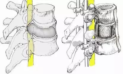 筋骨堂筋膜刀,筋骨堂整脊