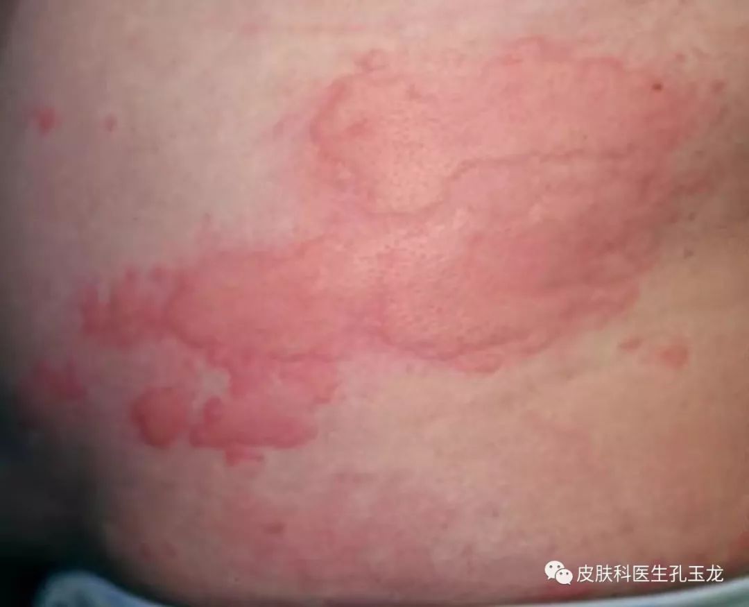 慢性荨麻疹怎么治才能去根,慢性荨麻疹用什么药