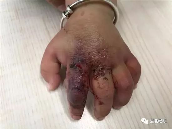 10个月大宝宝手指莫名的肿了,一岁宝宝手肿得像馒头